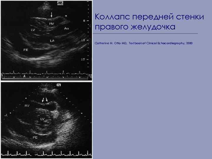 Коллапс передней стенки правого желудочка Catherine M. Otto MD, Textbook of Clinical Echocardiography, 2000