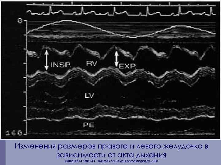 Изменения размеров правого и левого желудочка в зависимости от акта дыхания Catherine M. Otto