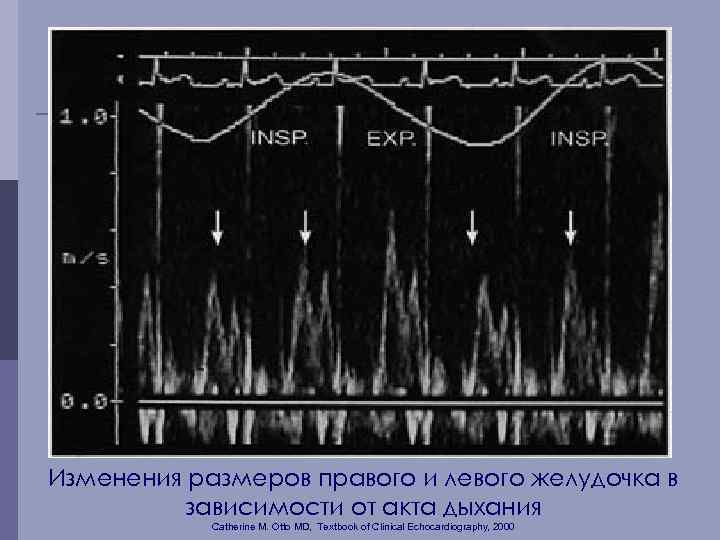 Изменения размеров правого и левого желудочка в зависимости от акта дыхания Catherine M. Otto