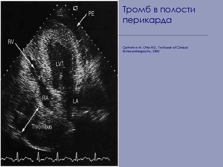 Тромб в полости перикарда Catherine M. Otto MD, Textbook of Clinical Echocardiography, 2000 