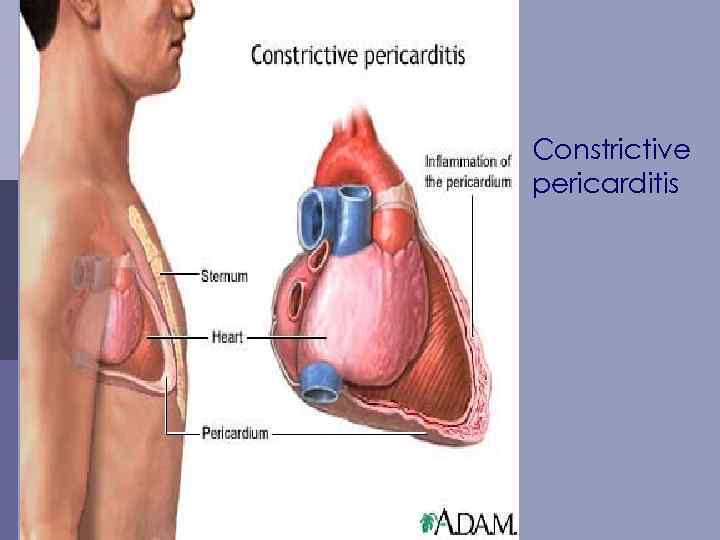 Constrictive pericarditis 