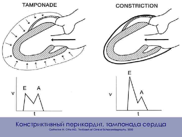 Констриктивный перикардит, тампонада сердца Catherine M. Otto MD, Textbook of Clinical Echocardiography, 2000 