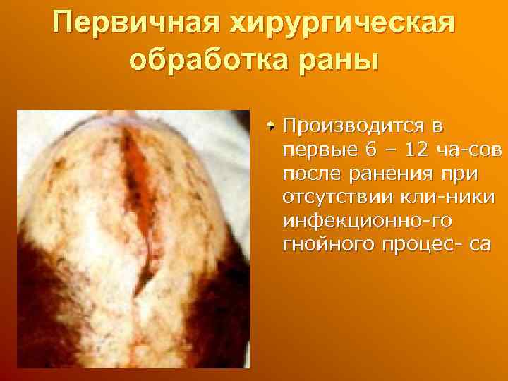 Первичная хирургическая обработка раны Производится в первые 6 – 12 ча-сов после ранения при