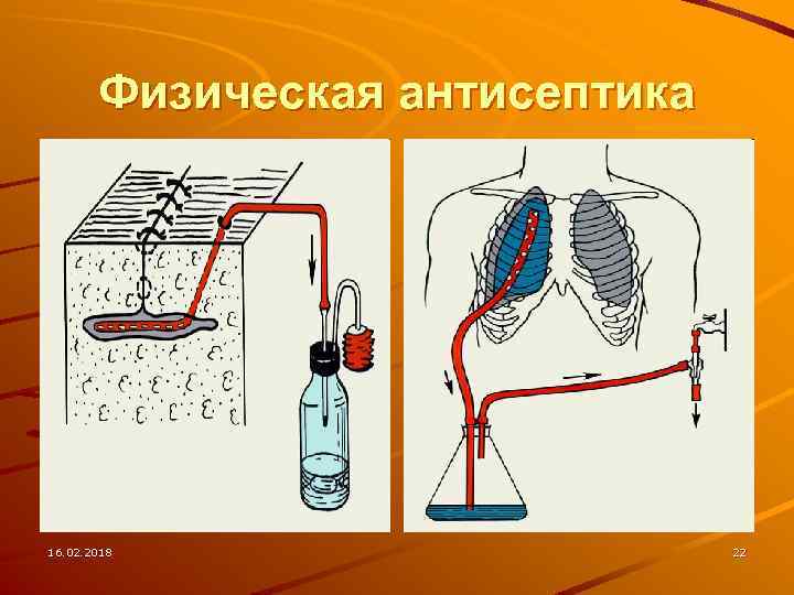 Физическая антисептика 16. 02. 2018 22 