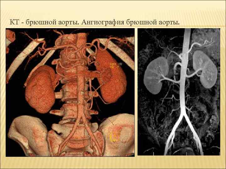 КТ - брюшной аорты. Ангиография брюшной аорты. 