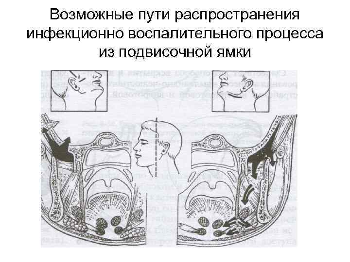 Возможные пути распространения инфекционно воспалительного процесса из подвисочной ямки 