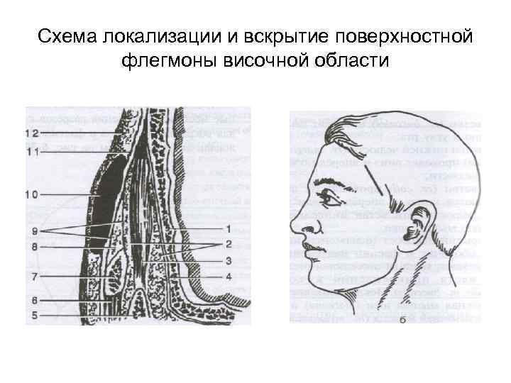 Схема локализации и вскрытие поверхностной флегмоны височной области 