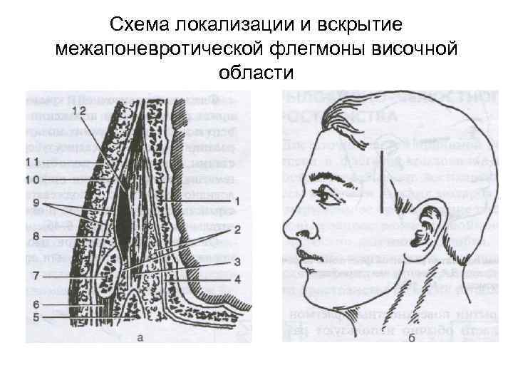 Схема локализации и вскрытие межапоневротической флегмоны височной области 