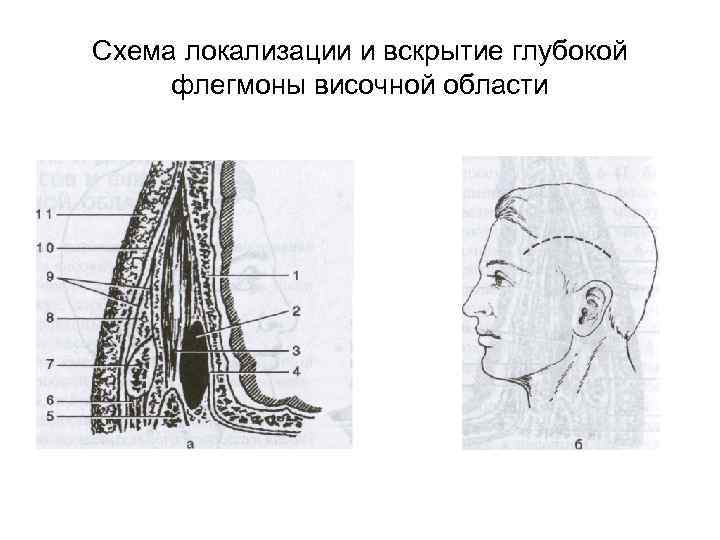 Схема локализации и вскрытие глубокой флегмоны височной области 