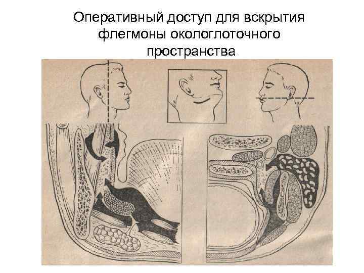 Оперативный доступ для вскрытия флегмоны окологлоточного пространства 