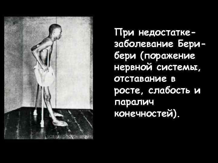 При недостаткезаболевание Берибери (поражение нервной системы, отставание в росте, слабость и паралич конечностей). 