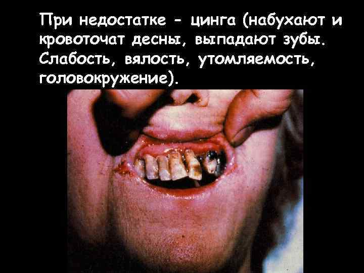 При недостатке - цинга (набухают и кровоточат десны, выпадают зубы. Слабость, вялость, утомляемость, головокружение).