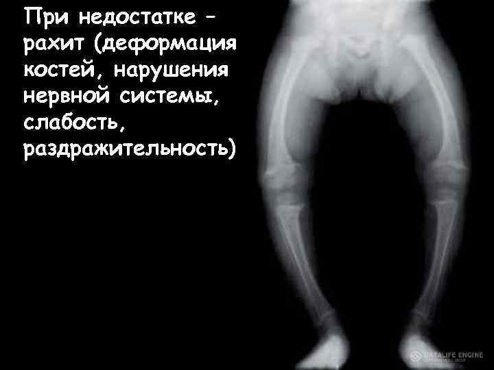 При недостатке – рахит (деформация костей, нарушения нервной системы, слабость, раздражительность) 