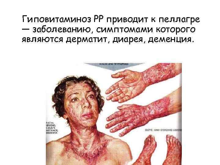 Гиповитаминоз РР приводит к пеллагре — заболеванию, симптомами которого являются дерматит, диарея, деменция. 