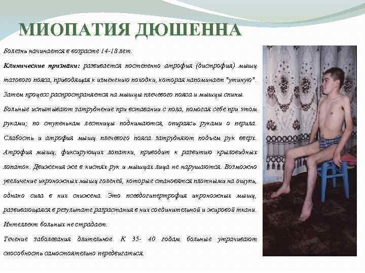 МИОПАТИЯ ДЮШЕННА Болезнь начинается в возрасте 14 -18 лет. Клинические признаки: развивается постепенно атрофия