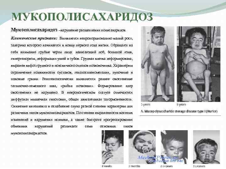 МУКОПОЛИСАХАРИДОЗ Мукополисахаридоз –нарушение расщепления полисахаридов. Клинические признаки: Выявляется непропорционально малый рост, задержка которого начинается
