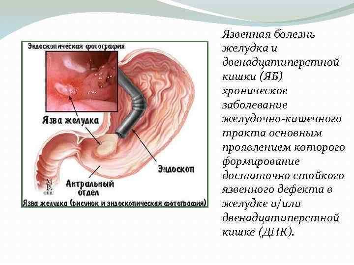 Язвенная болезнь желудка и двенадцатиперстной кишки (ЯБ) хроническое заболевание желудочно-кишечного тракта основным проявлением которого