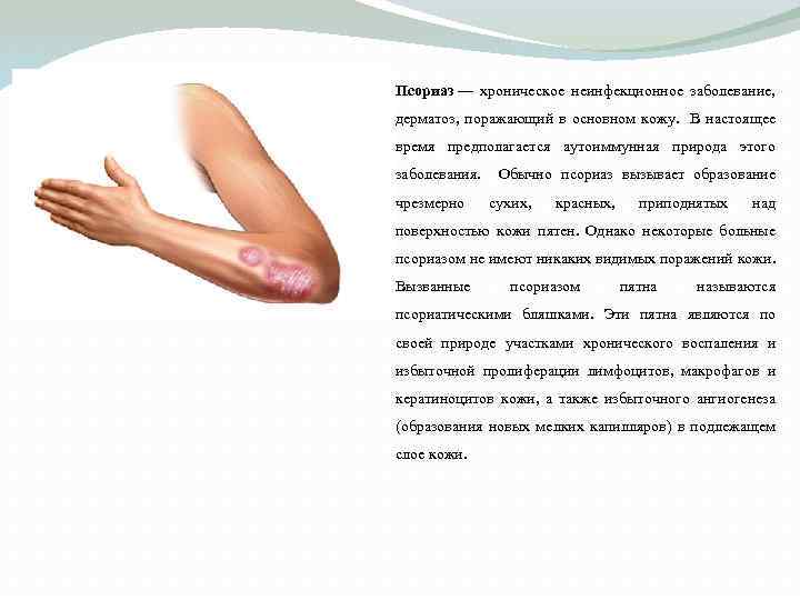 Псориаз — хроническое неинфекционное заболевание, дерматоз, поражающий в основном кожу. В настоящее время предполагается