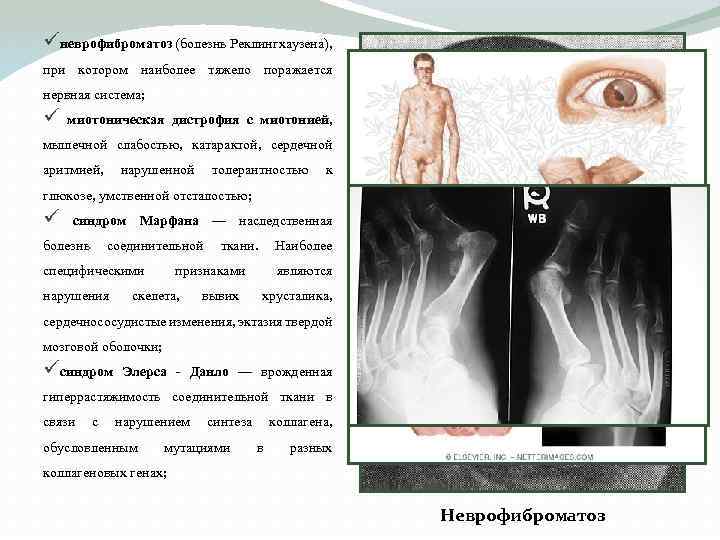 üневрофиброматоз (болезнь Реклингхаузена), при котором наиболее тяжело поражается нервная система; ü миотоническая дистрофия с