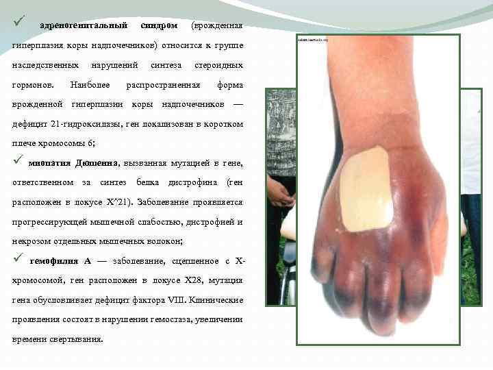 ü адреногенитальный синдром (врожденная гиперплазия коры надпочечников) относится к группе наследственных гормонов. нарушений Наиболее