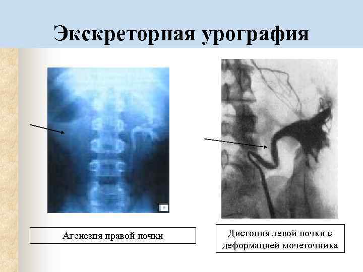 Экскреторная урография рентгенологическое исследование почек относится к функциональным изображениям