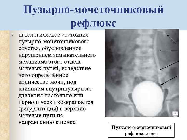 Степени пузырно мочеточникового рефлюкса