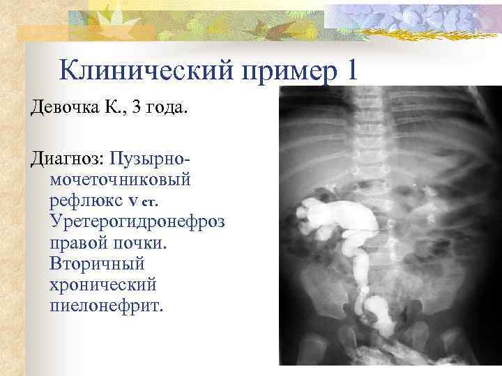 Клинический пример 1 Девочка К. , 3 года. Диагноз: Пузырномочеточниковый рефлюкс V ст. Уретерогидронефроз