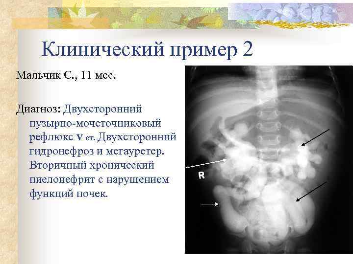 Клинический пример 2 Мальчик С. , 11 мес. Диагноз: Двухсторонний пузырно-мочеточниковый рефлюкс V ст.