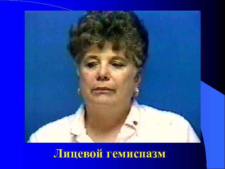 Лицевой гемиспазм 