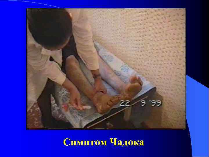 Симптом Чадока 