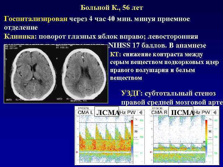 Клиническая картина инсульта