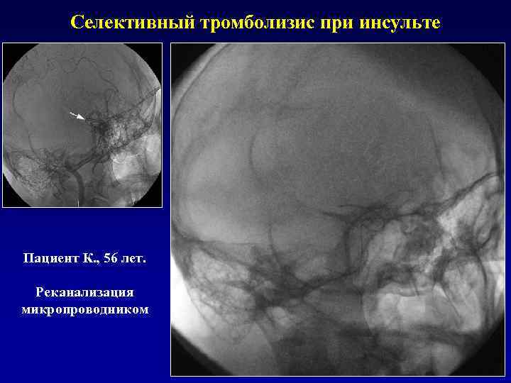 Селективный тромболизис при инсульте Пациент К. , 56 лет. Реканализация микропроводником 
