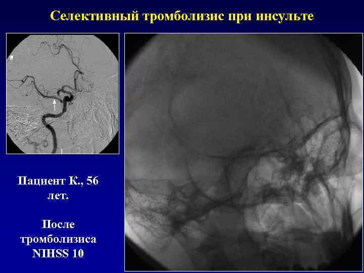 Селективный тромболизис при инсульте Пациент К. , 56 лет. После тромболизиса NIHSS 10 