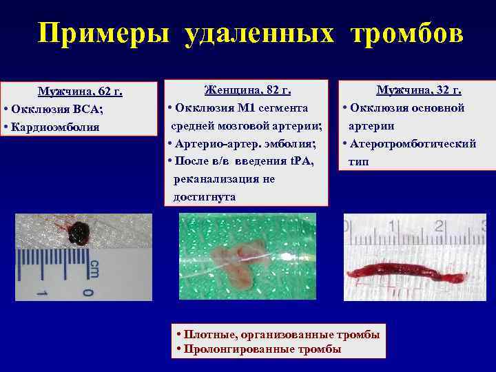 Примеры удаленных тромбов Мужчина, 62 г. • Окклюзия ВСА; • Кардиоэмболия Женщина, 82 г.