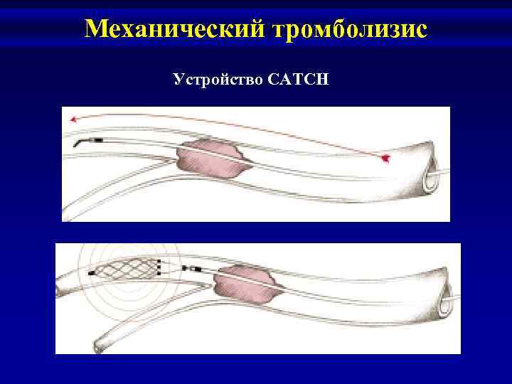 Механический тромболизис Устройство CATCH 
