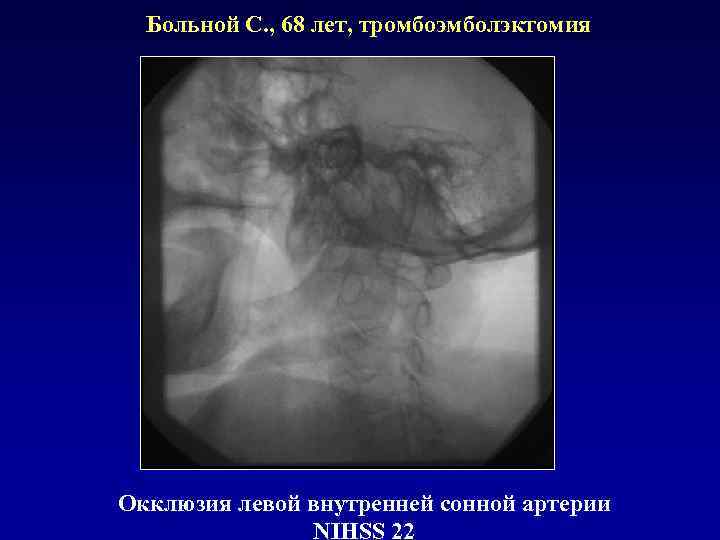 Больной С. , 68 лет, тромбоэмболэктомия Окклюзия левой внутренней сонной артерии NIHSS 22 