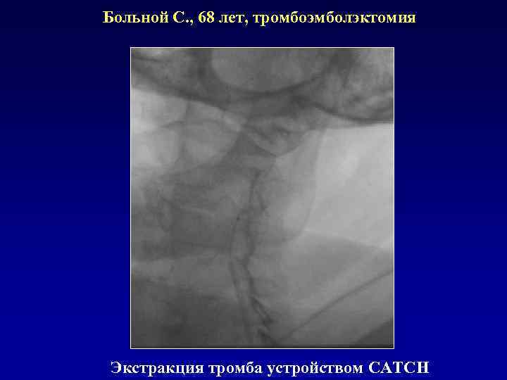 Больной С. , 68 лет, тромбоэмболэктомия Экстракция тромба устройством CATCH 