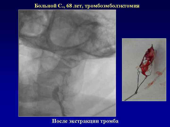 Больной С. , 68 лет, тромбоэмболэктомия После экстракции тромба 