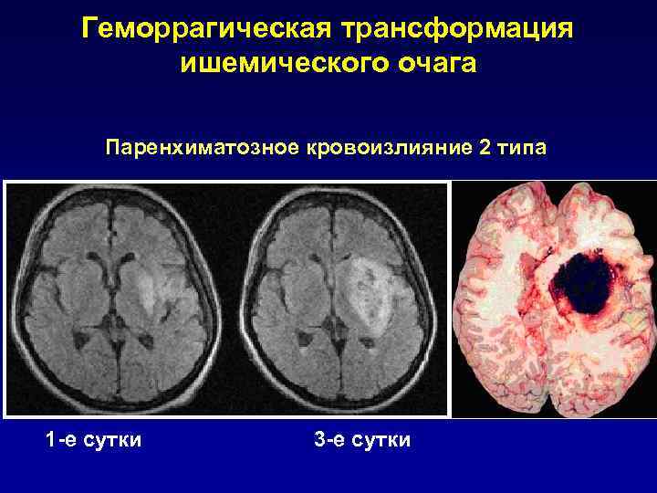 Очаги ишемии головного мозга