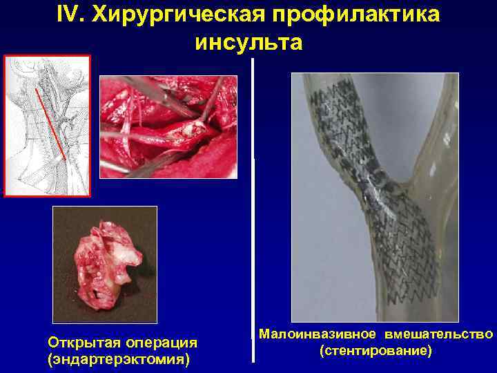 IV. Хирургическая профилактика инсульта Открытая операция (эндартерэктомия) Малоинвазивное вмешательство (стентирование) 