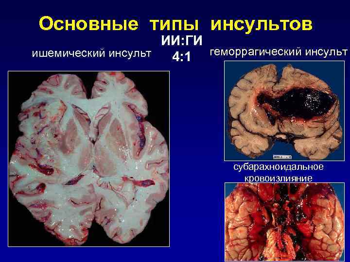 Основные типы инсультов ИИ: ГИ ишемический инсульт 4: 1 геморрагический инсульт субарахноидальное кровоизлияние 