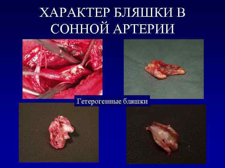 ХАРАКТЕР БЛЯШКИ В СОННОЙ АРТЕРИИ Гетерогенные бляшки 