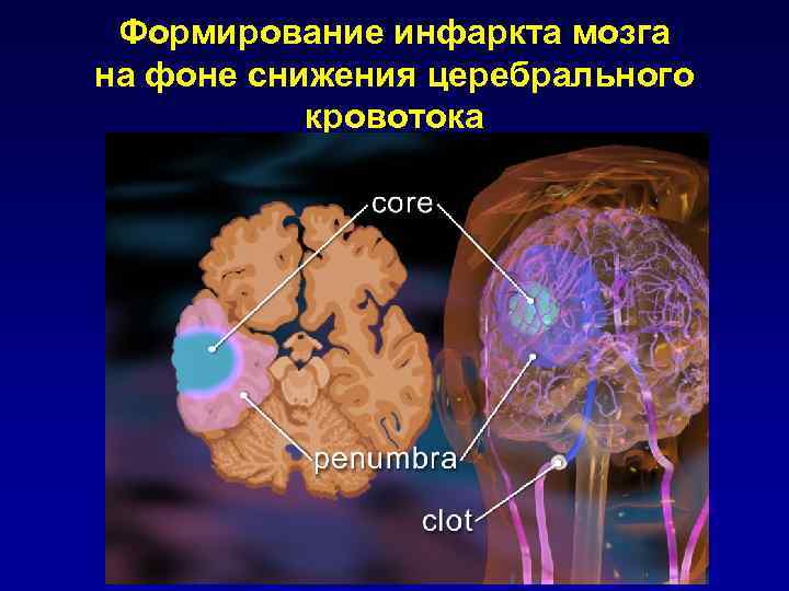 Клиническая картина инсульта