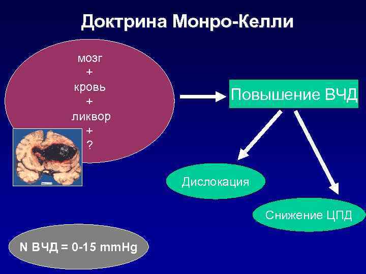 Доктрина Монро-Келли мозг + кровь + ликвор + ? Повышение ВЧД Дислокация Снижение ЦПД