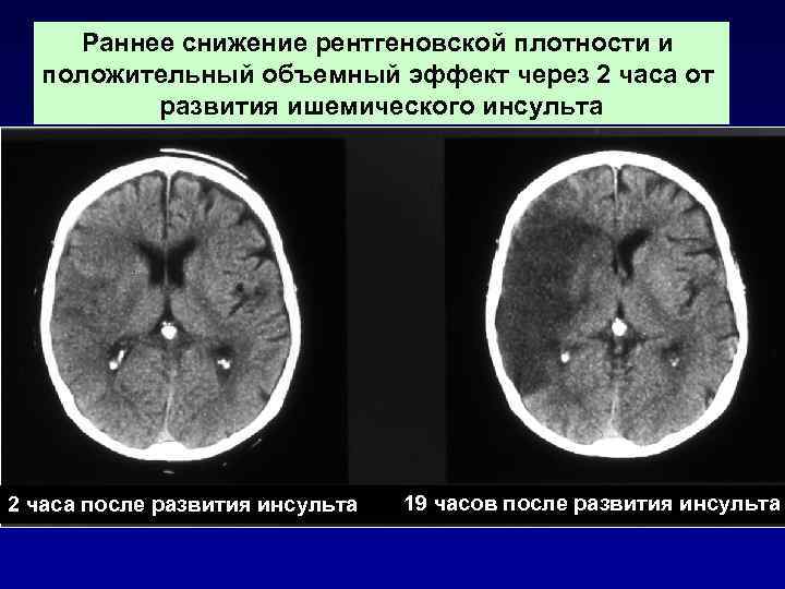 Клинические рекомендации ишемический инсульт и транзиторная ишемическая