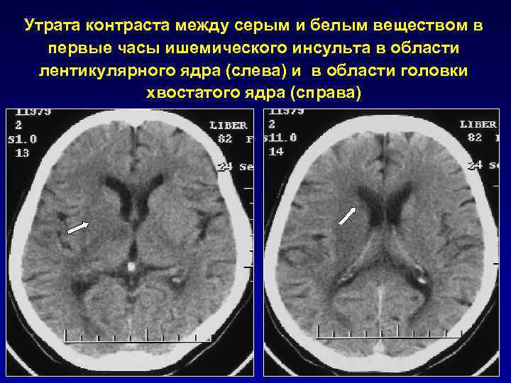 Клиническая картина инсульта