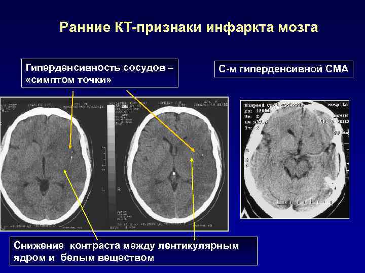 Клиническая картина инсульта