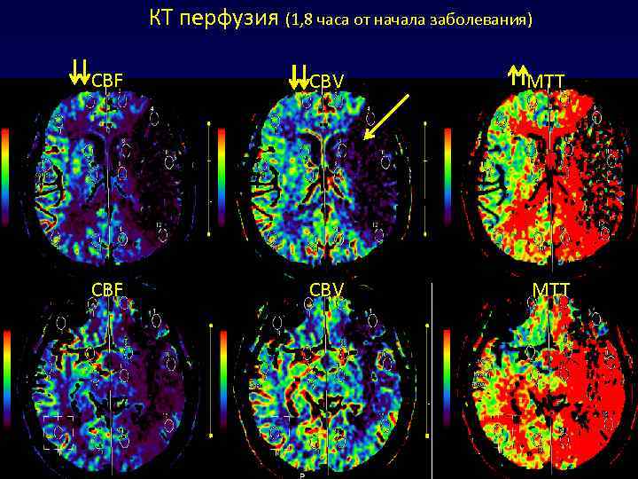 КТ перфузия (1, 8 часа от начала заболевания) CBF CBV MTT 