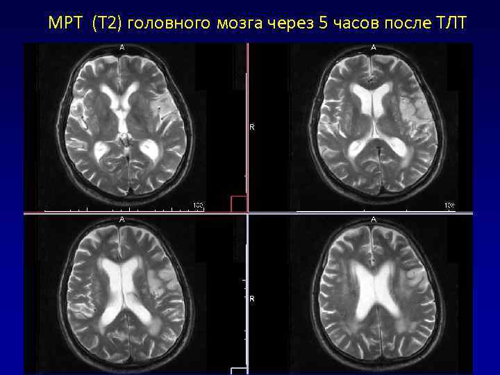 Лейкоэнцефалопатия кт картина