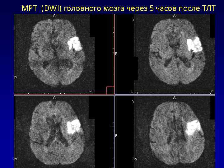 МРТ (DWI) головного мозга через 5 часов после ТЛТ 